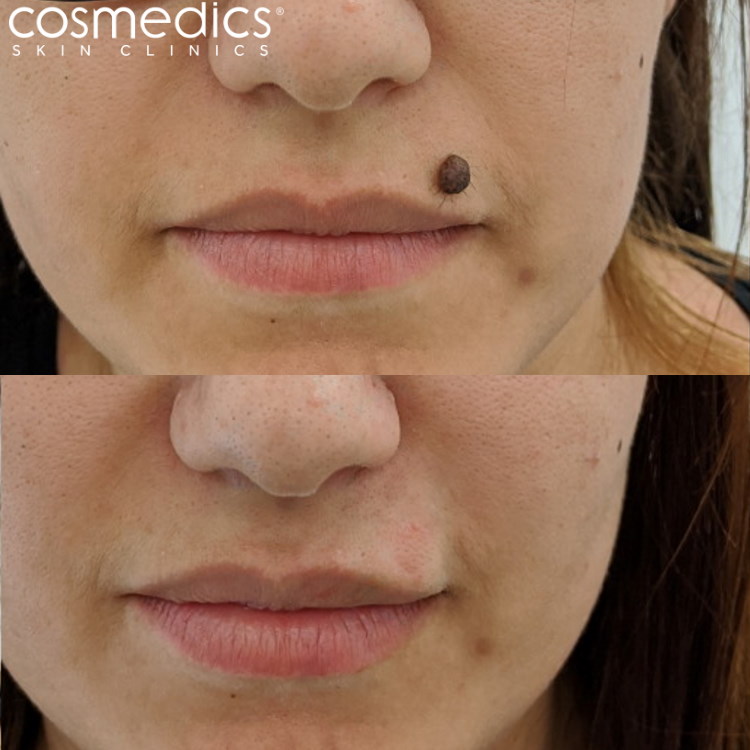 Large facial mole removal results