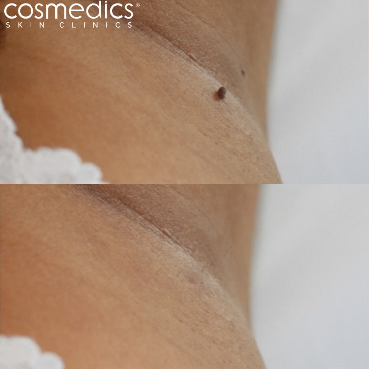 Skin tag removal results