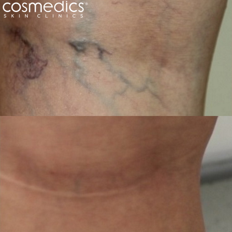 Thread vein treatment before and after